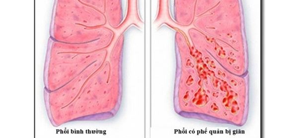 Giãn phế quản sau lao