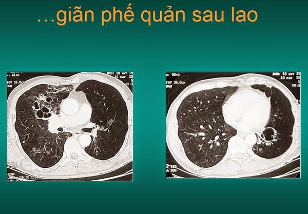 Những Thông Tin Cần Biết Về Giãn Phế Quản Sau Lao