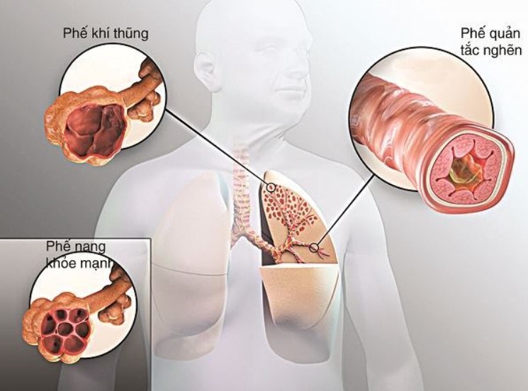 Một số câu hỏi thường gặp về COPD và cách giải đáp