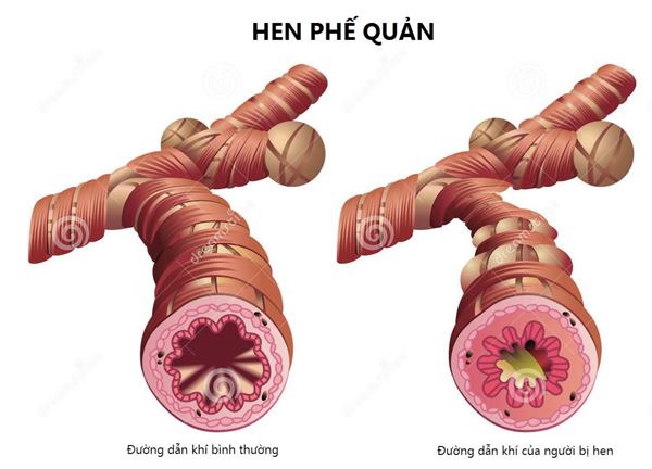 hen phế quản dị ứng - nỗi "ám ảnh" của nhiều người!