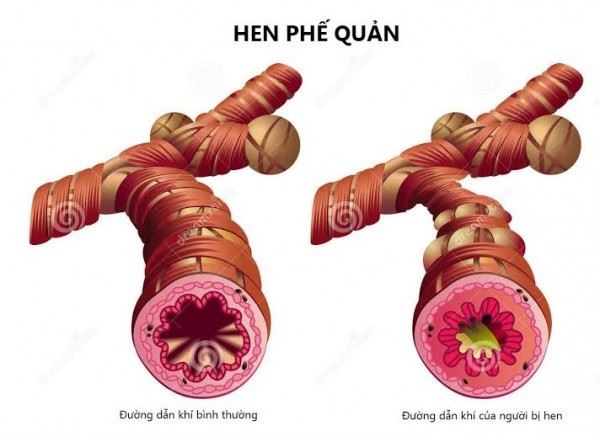 Bài thuốc chữa hen phế quản