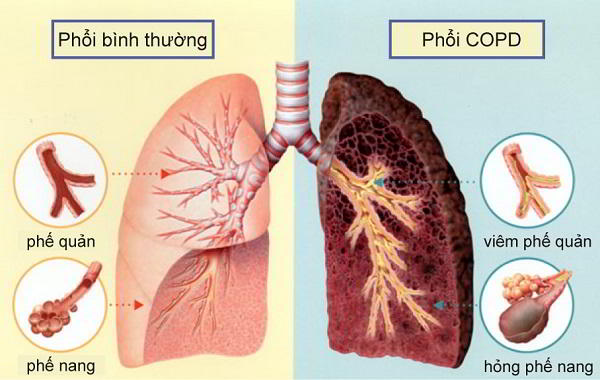 bệnh khí phế thũng