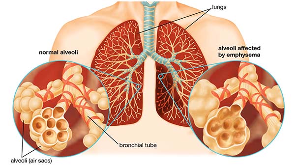 Bệnh phổi tắc nghẽn mạn tính COPD giai đoạn 1