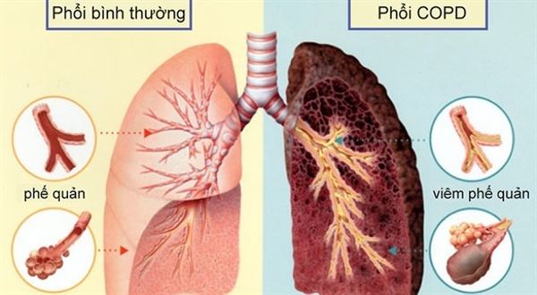 Bệnh phổi tắc nghẽn mãn tính