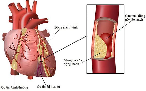 Bệnh tim mạch gây cảm giác đau tức ở ngực giữa