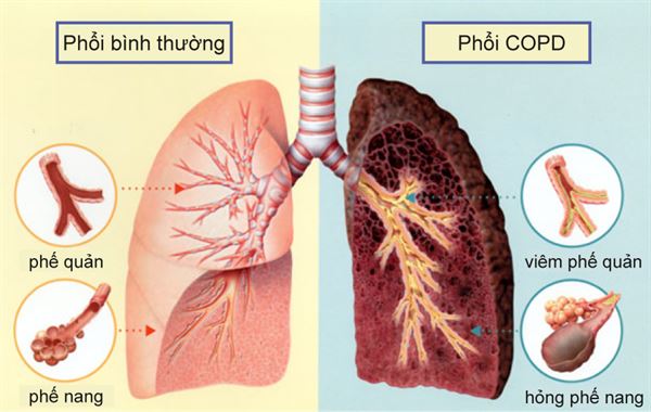 COPD gây tràn khí màng phổi