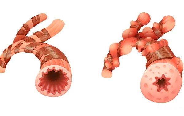 Giãn phế quản có nguy hiểm không?