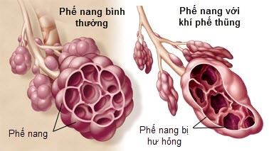 khi-phe-thung-hay-vo-phe-nang