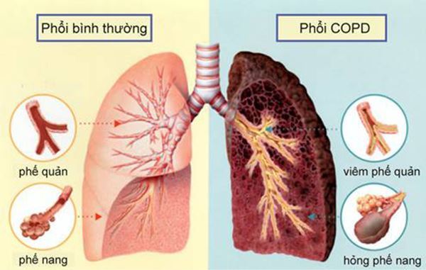 Phổi bệnh nhân COPD