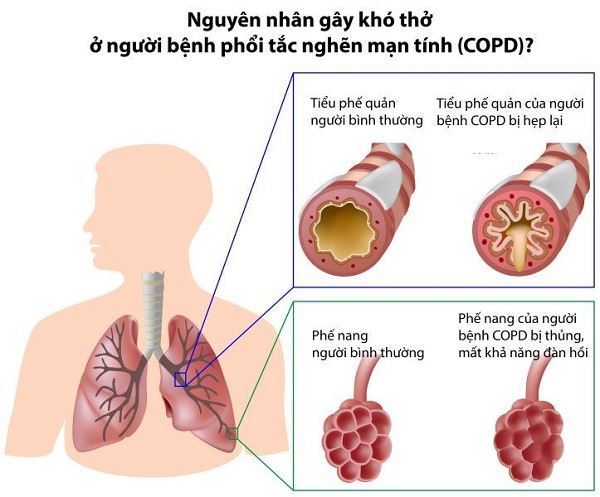 bệnh phổi tắc nghẽn mạn tính gây khó thở