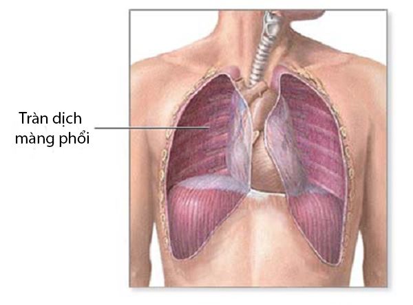 tràn dịch màng phổi