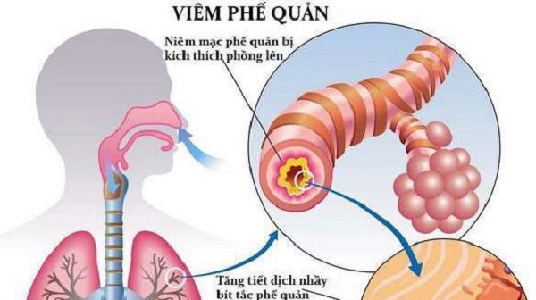 Bệnh viêm phế quản mãn tính