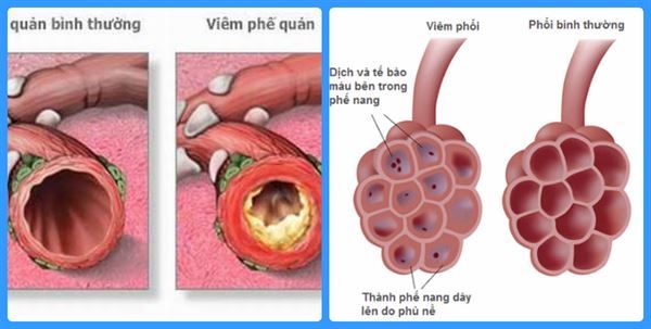 viêm phế quản và viêm phổi khác nhau