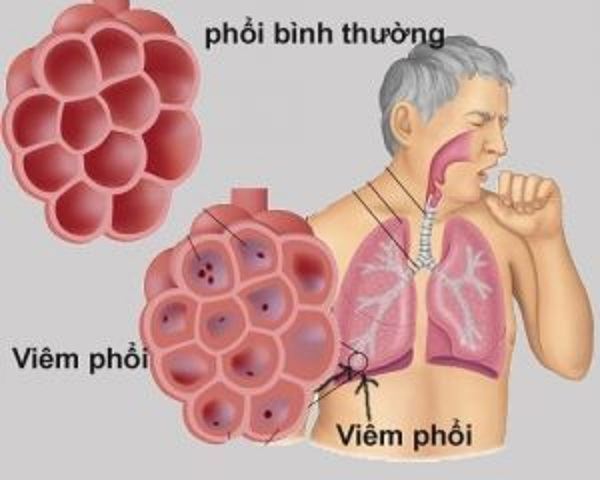 viêm phổi gây thở nông