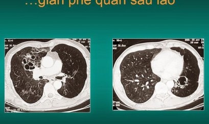 Thông tin cần biết về giãn phế quản sau lao