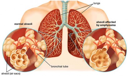 benh-phoi-tac-nghen-giai-doan-1