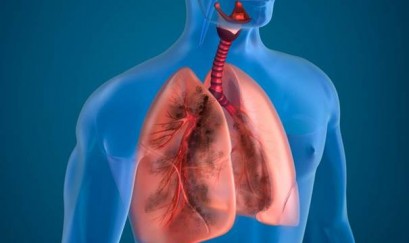 benh-phoi-tac-nghen-giai-doan-4