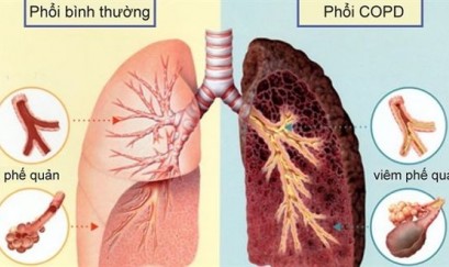  Cẩm nang sức khỏe cho người bệnh phổi tắc nghẽn mạn tính – COPD