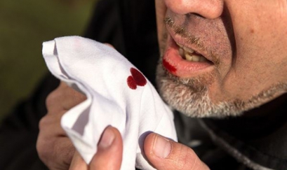 Tất cả sự thật về sự nguy hiểm của hiện tượng ho ra máu