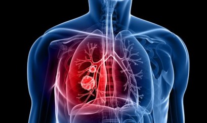 Điểm nổi bật trong điều trị COPD theo GOLD 2018