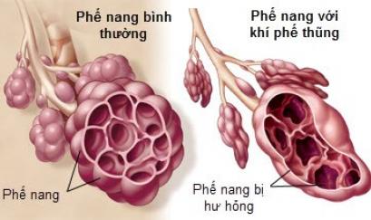 Bệnh khí phế thũng là gì - nguyên nhân và cách kiểm soát