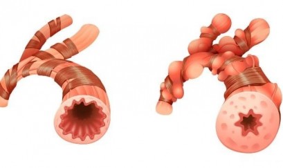 Bệnh giãn phế quản có nguy hiểm không?