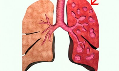 Tất tần tật mọi điều về bệnh giãn phế quản