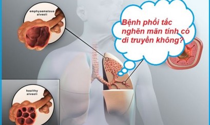  Is copd genetic - COPD có di truyền không?