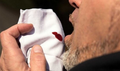 Triệu chứng ho, khạc đờm ra máu là bệnh gì?