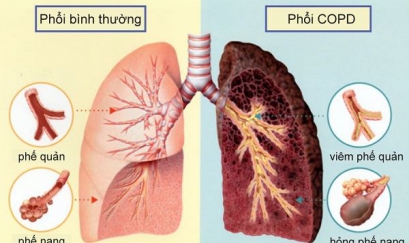 Bệnh phổi tắc nghẽn mạn tính có nguy hiểm không?