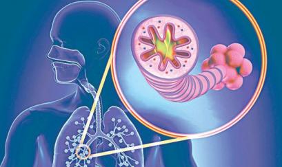 Chẩn đoán và Điều trị COPD theo Gold 2015-2018