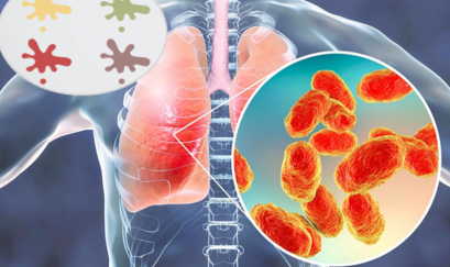 5 màu sắc của đờm “cảnh báo” phổi đang gặp nguy hiểm 