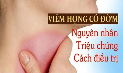 Cách chữa viêm họng, đau rát cổ họng có đờm