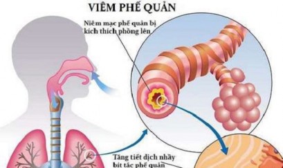 Cẩm nang sức khỏe cho người bệnh viêm phế quản mãn tính
