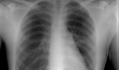 Bật mí những ý nghĩa “quan trọng” của X – quang COPD