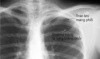 Tràn khí màng phổi - Biến chứng nguy hiểm của các bệnh lý hô hấp!