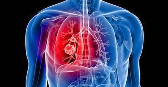 Ho đau ngực có liên quan đến các bệnh về phổi không?

